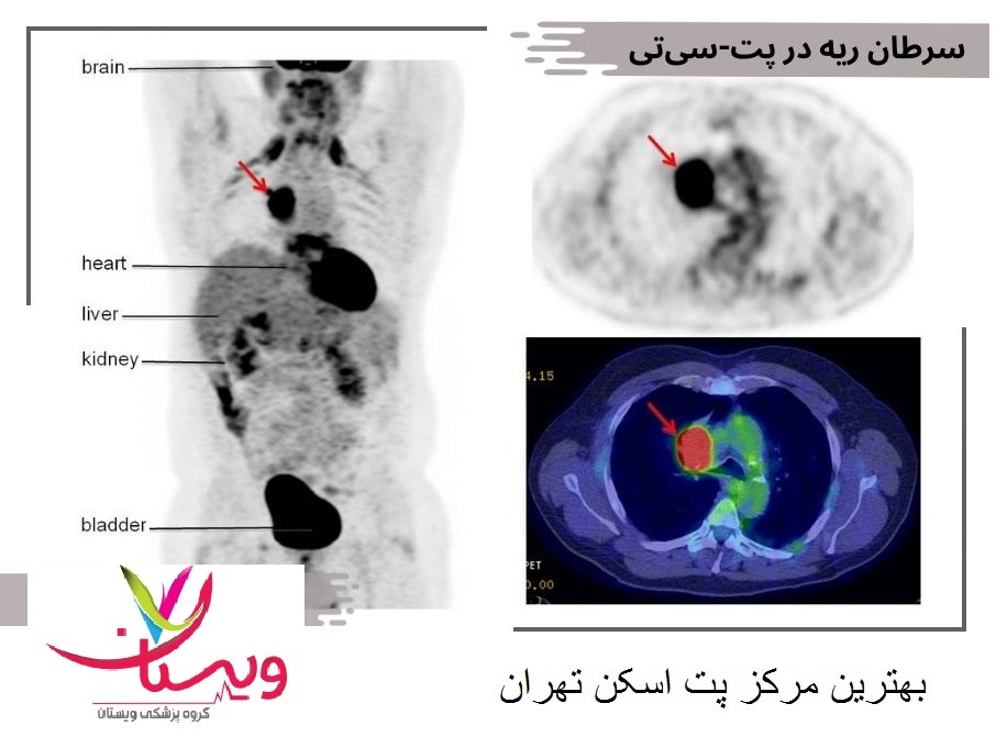 عکس پت اسکن سرطانی