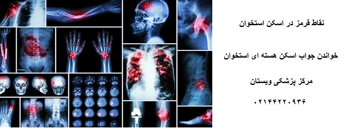 نقاط قرمز در اسکن استخوان