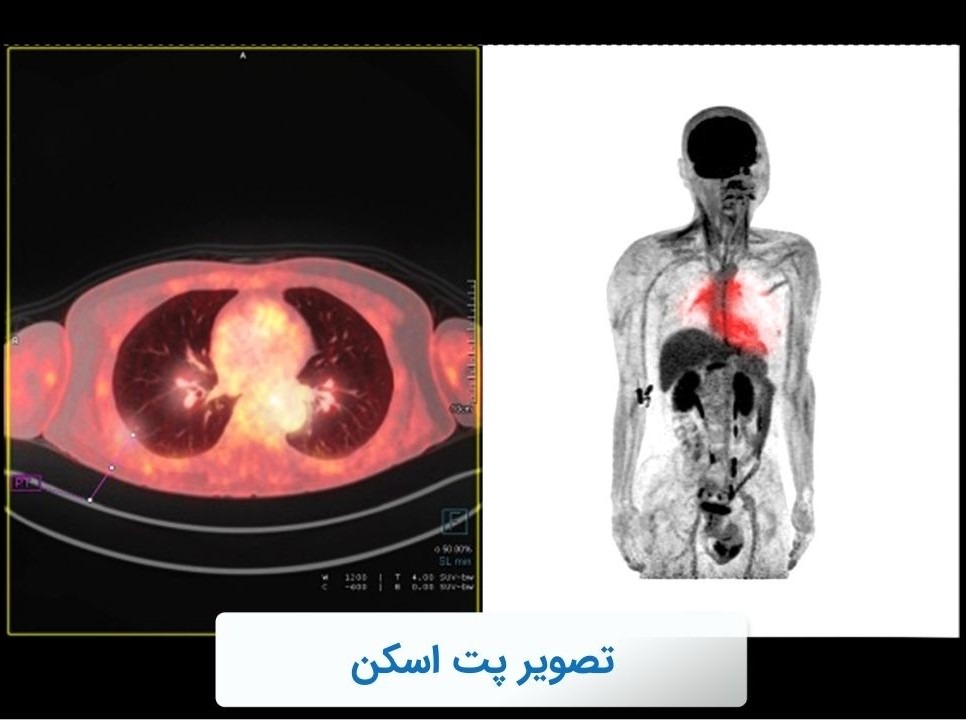 عکس پت اسکن سالم