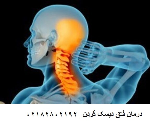 درمان فتق دیسک گردن