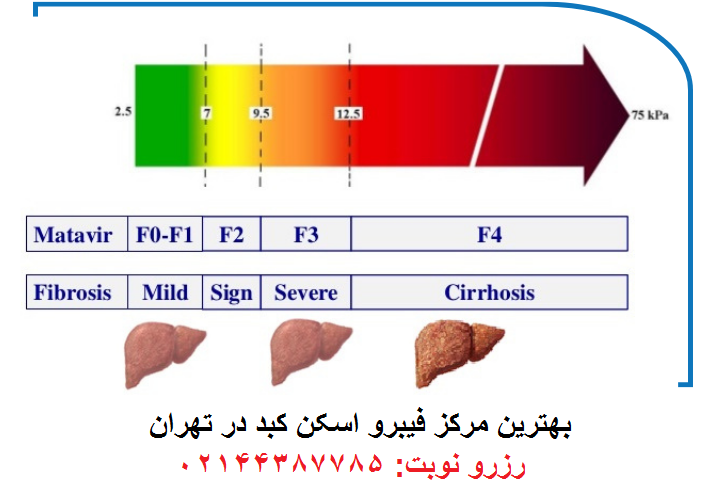 بهترین مرکز فیبرو اسکن کبد در تهران