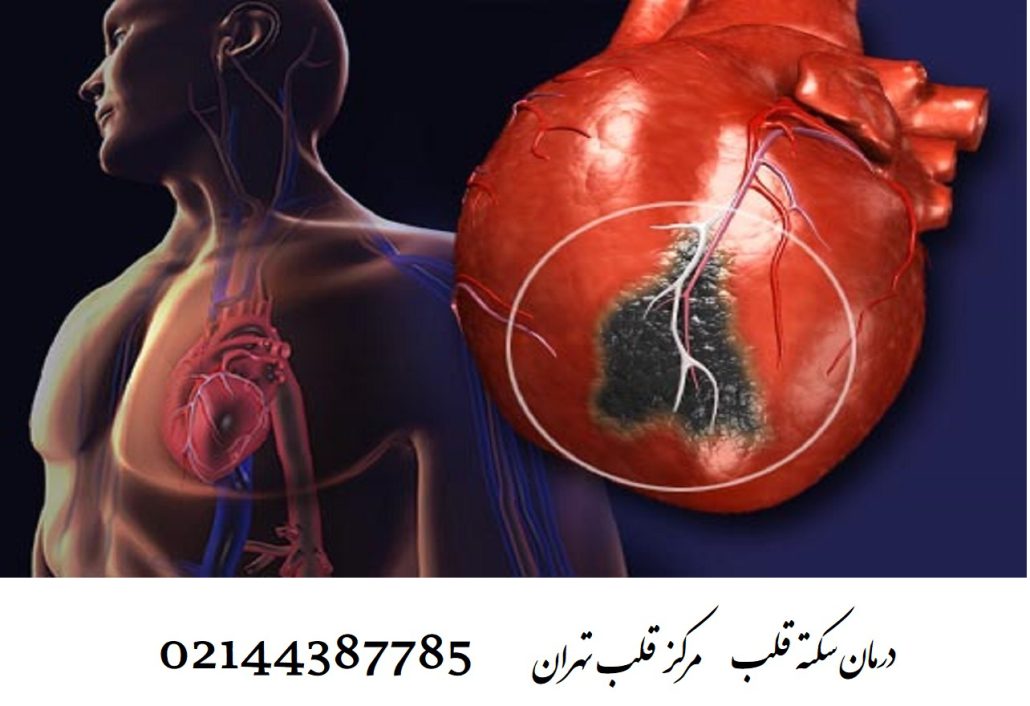 آیا سکته قلبی باعث مرگ میشود؟ آمار مرگ و میر بعداز سکته قلبی