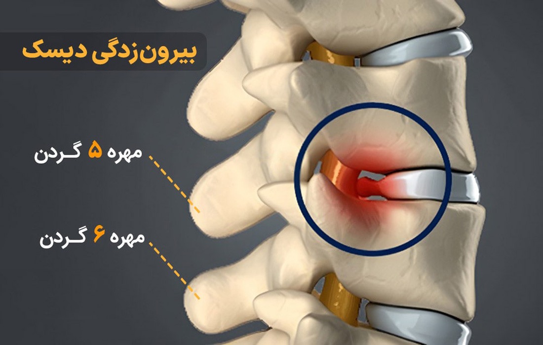 فتق دیسک گردن مهره ۵ و ۶