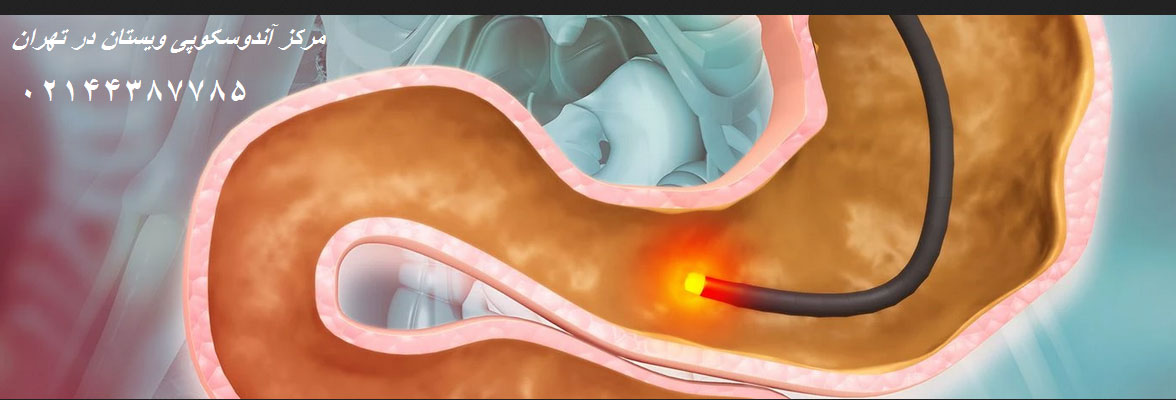 روند انجام آندوسکوپی