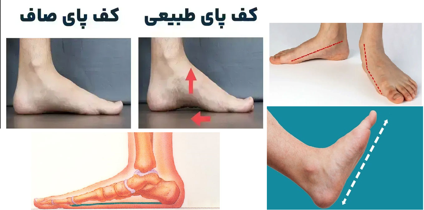 شکل کف پای صاف و قوس دار