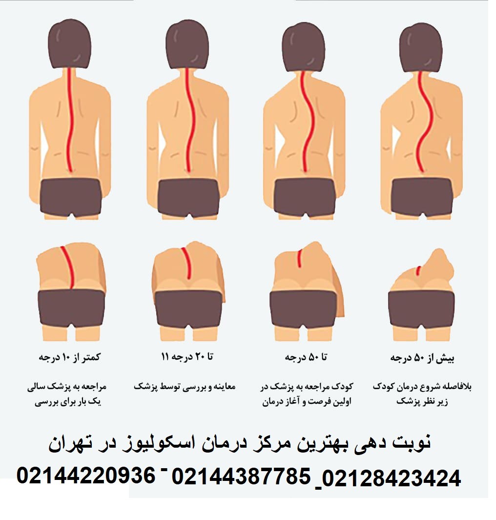 عکس اسکولیوز خفیف