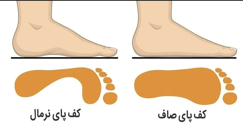 درمان صافی کف پا در نوجوانان