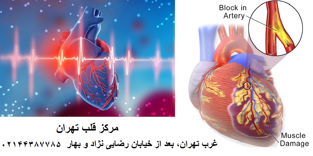 سکته قلبی چیست
