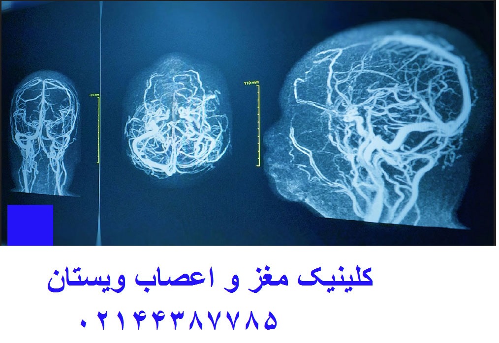 نحوه انجام سی تی آنژیو مغز