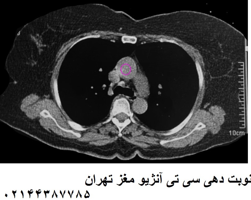 سی تی آنژیوگرافی مغز
