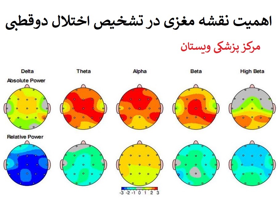 اهمیت نقشه مغزی در تشخیص اختلال دوقطبی