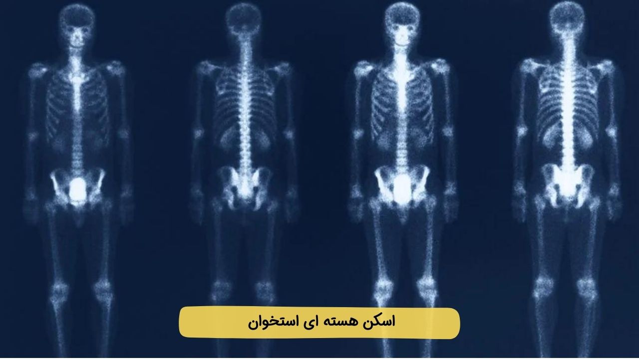 اسکن هسته ای برای تشخیص سرطان تیروئید