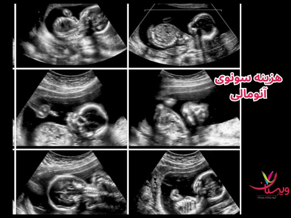 بهترین زمان سونوگرافی آنومالی