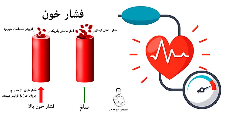 فشار خون بالا چند است؟