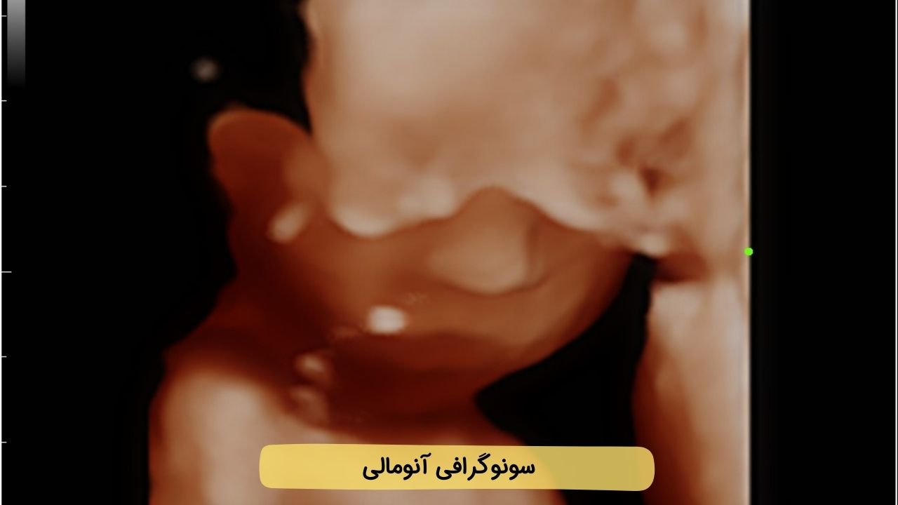 سونو آنومالی چیست؟ 