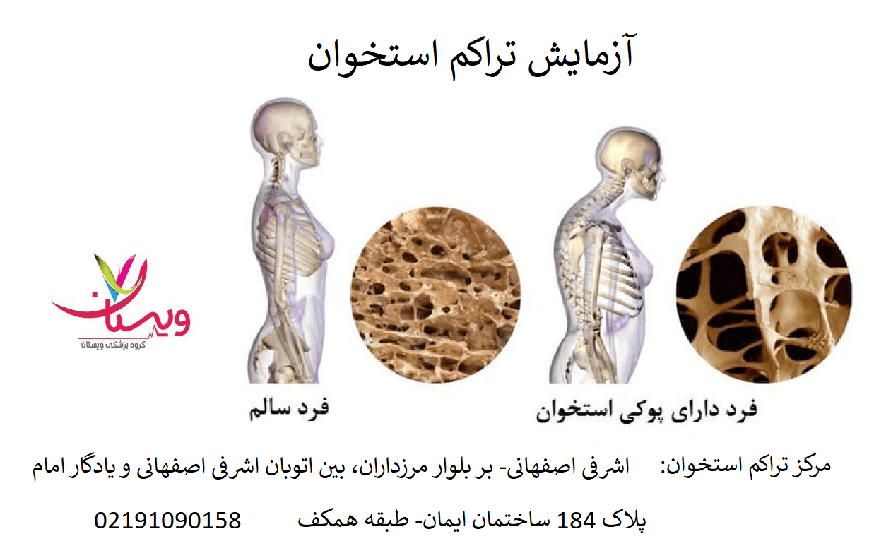 آزمایش تراکم استخوان 