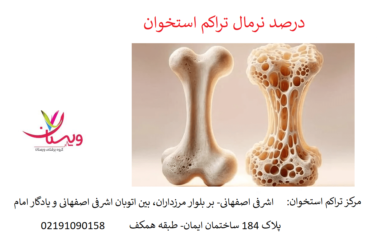 درصد نرمال تراکم استخوان