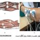 نوار عصب و عضله برای گزگز دست | کشف علت گزگز دست با تست emg