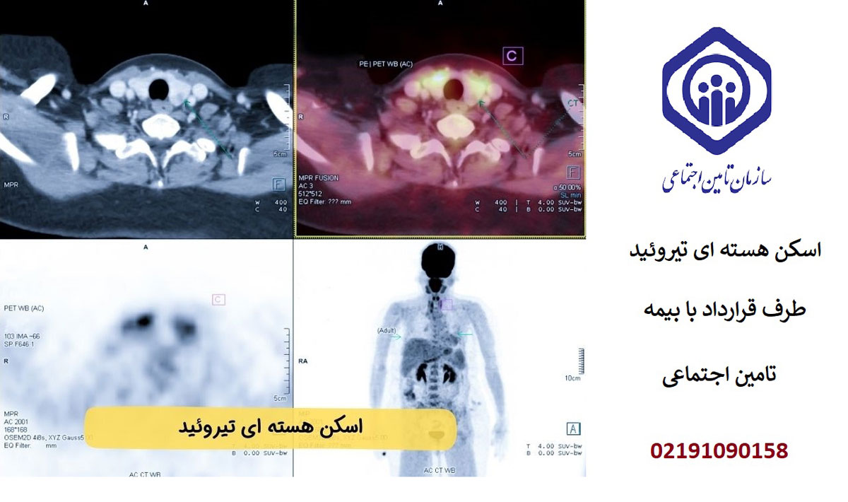 هزینه اسکن هسته ای پاراتیروئید با بیمه تامین اجتماعی