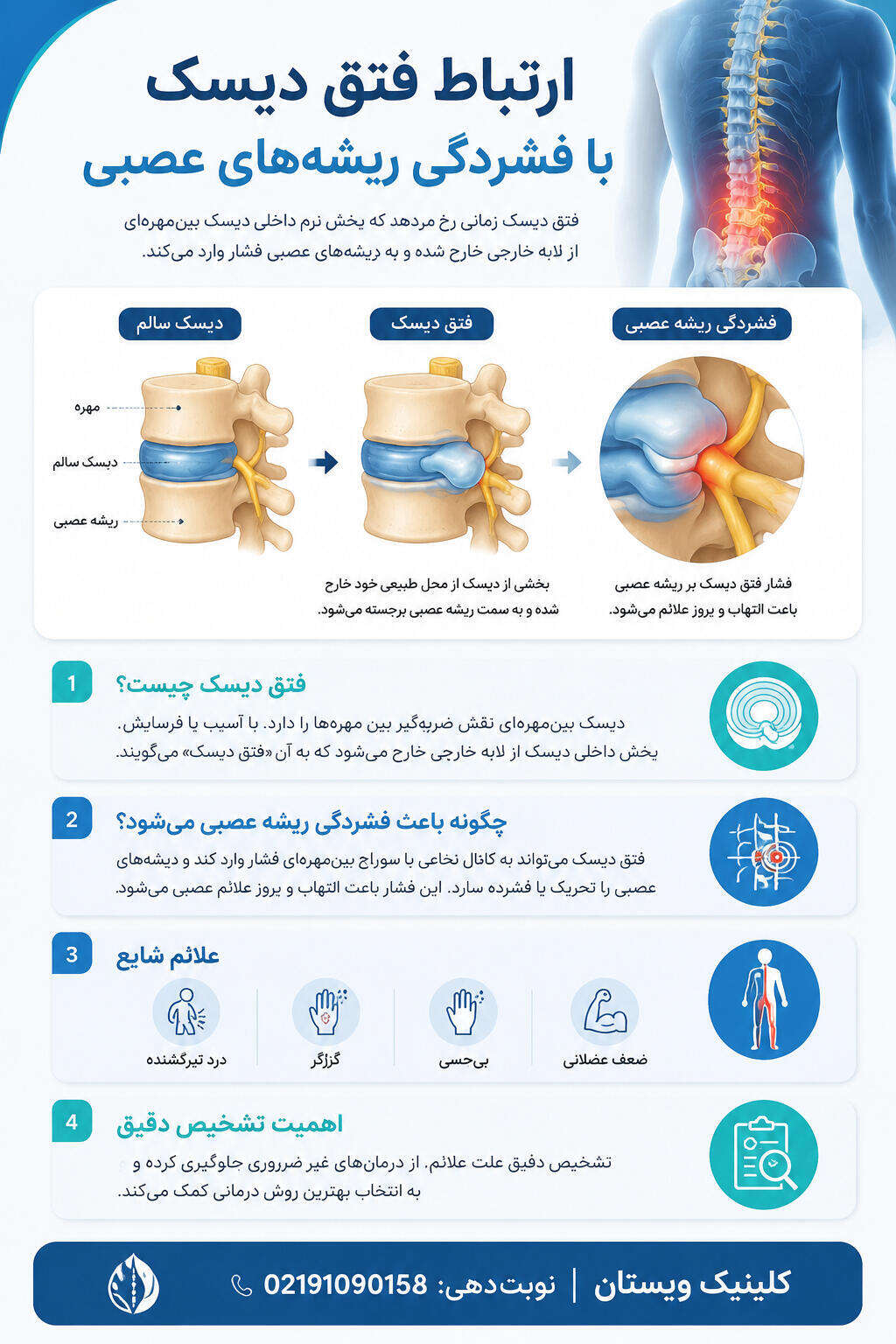 ارتباط فتق دیسک با فشردگی ریشه های عصبی