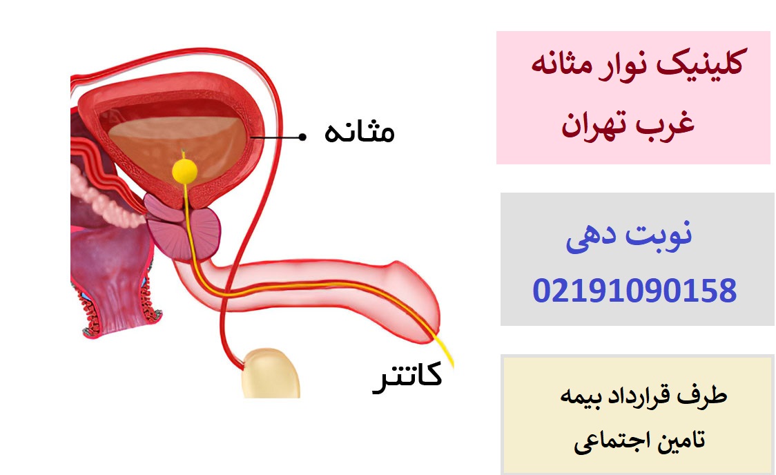مرکز نوار مثانه در غرب تهران