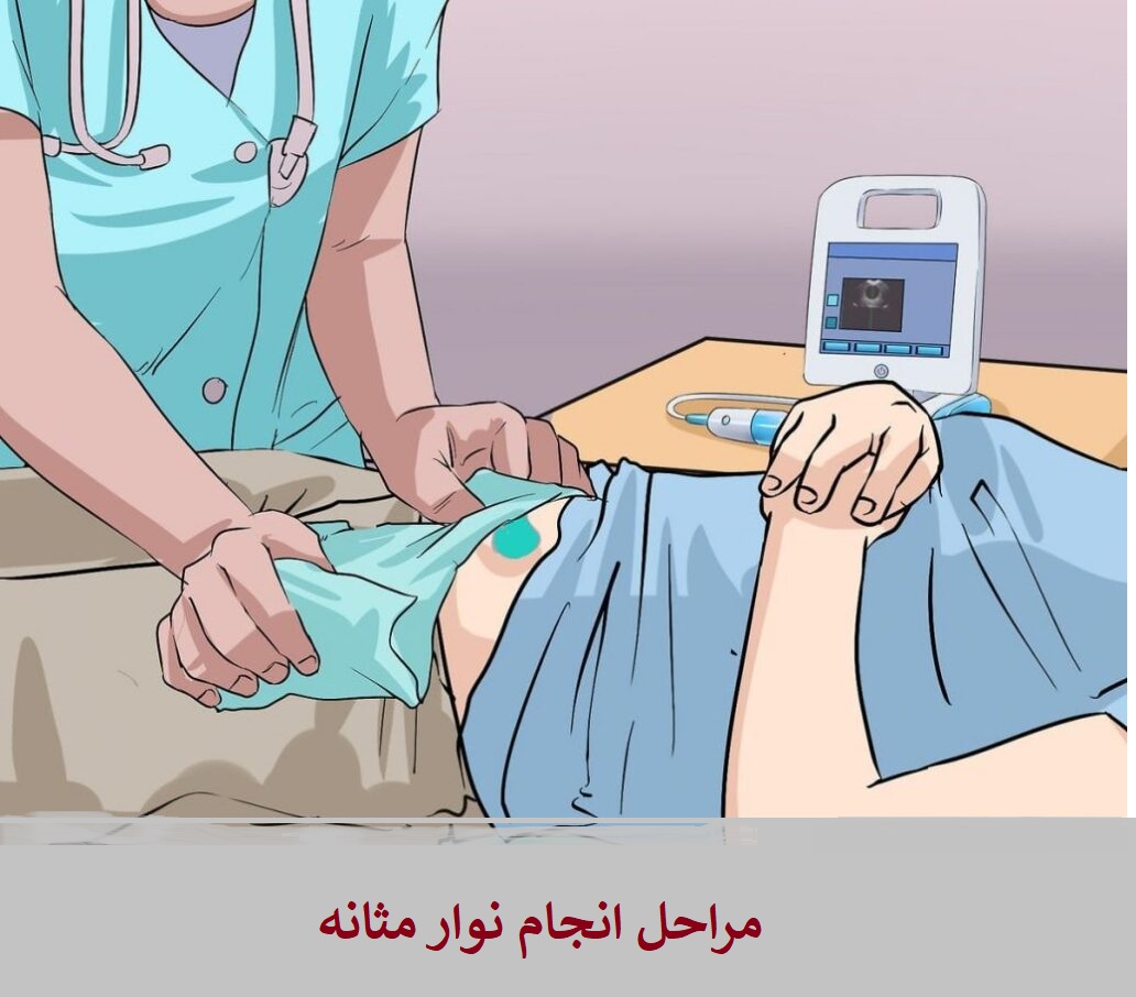 مراحل انجام نوار مثانه در غرب تهران