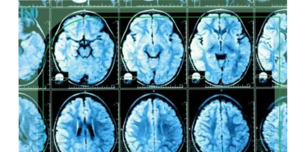 تفسیر نتیجه MRI (بررسی معیارهای سیستم PI-RADS)