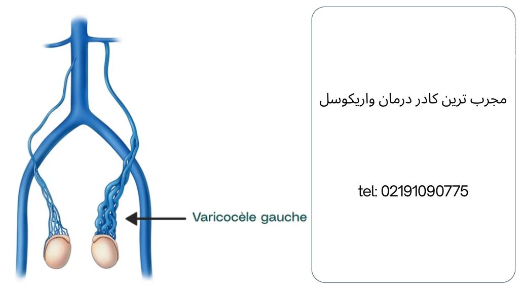 هزینه عمل واریکوسل با بیمه