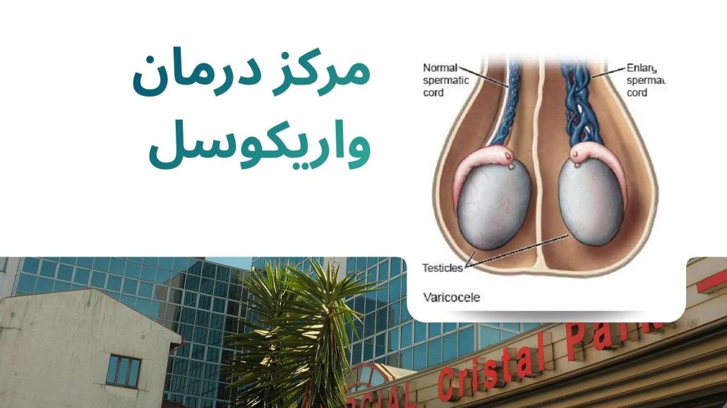 مرکز درمان واریکوسل